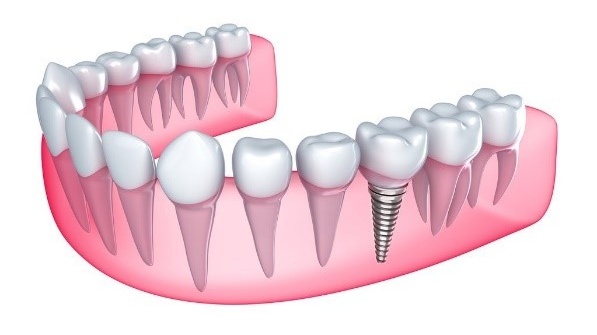 implant-nobel-la-gi-uu-diem-cua-tru-implant-nobel 3