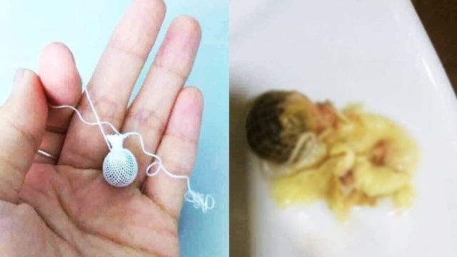 Kén đặt phụ khoa là gì? Có nên dùng kén đặt phụ khoa? 2