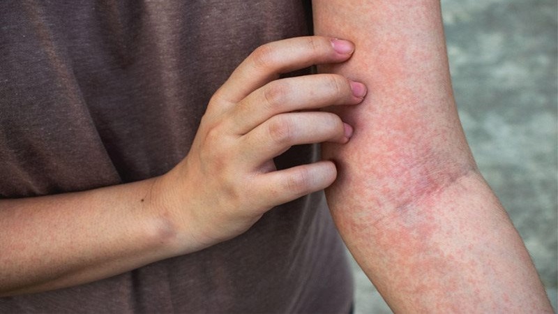 Khám sốt xuất huyết ở đâu Hà Nội uy tín, chất lượng? 1