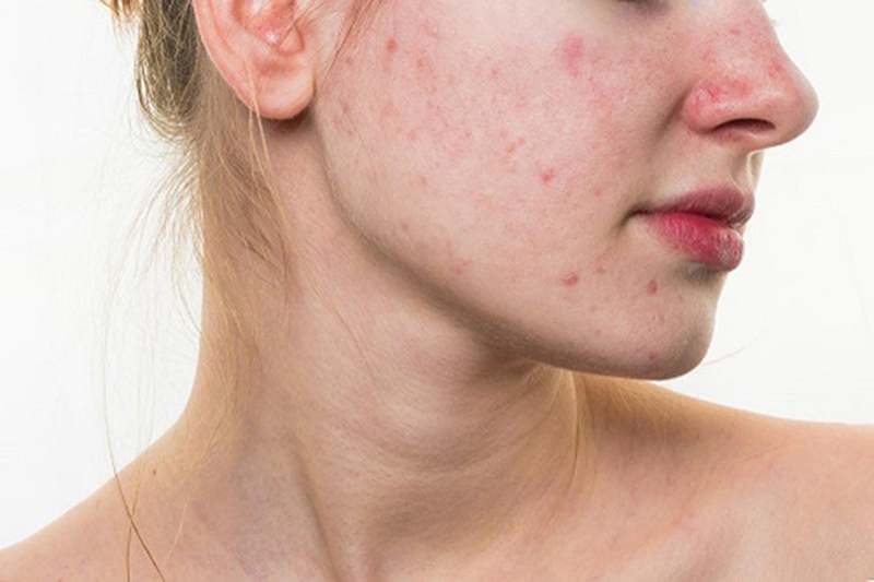 Chiết xuất lá khế có thể hỗ trợ kiểm soát dầu và chăm sóc làn da dễ nổi mụn