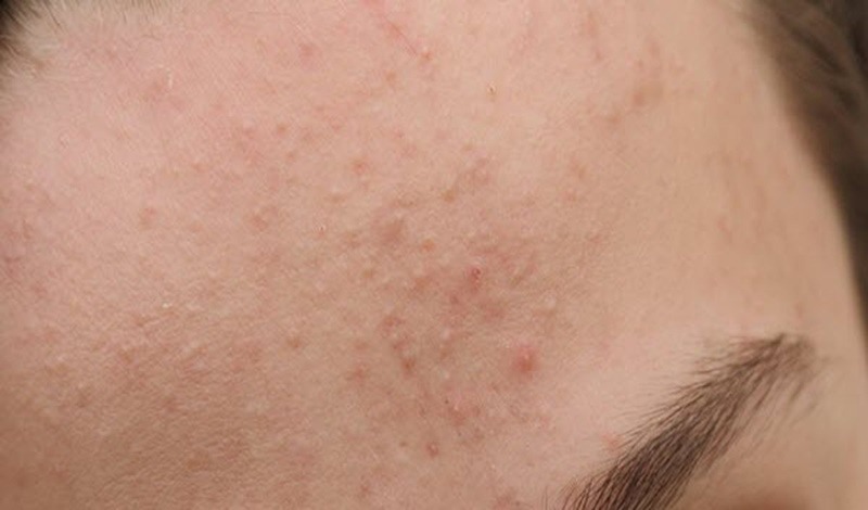 Khi dùng BHA bị đẩy mụn thì có nên nặn không? 2