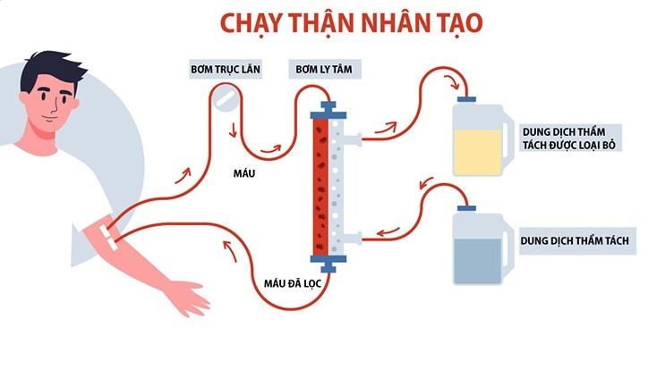 Khi nào cần phải chạy thận nhân tạo? 1