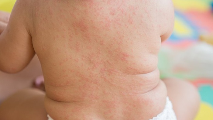 Khoa truyền nhiễm gồm những bệnh gì? 1