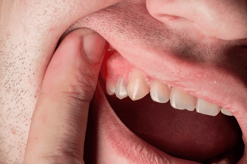 Khối u trong miệng có thể là biểu hiện của viêm nướu tăng sinh