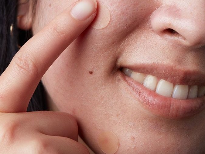 Không còn lo mụn với Miếng dán mụn ban ngày Derma Angel 2