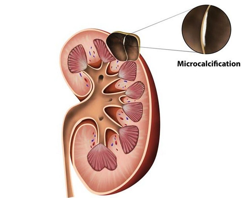 Kích thước nang thận to bao nhiêu thì phải mổ? 1