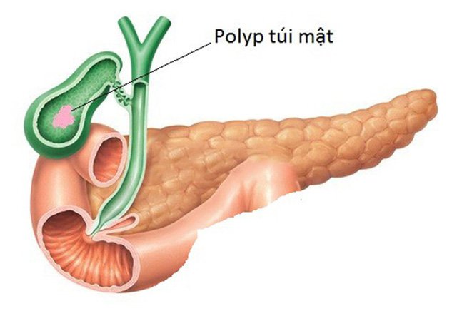 kich-thuoc-polyp-tui-mat-8mm-phai-lam-gi-de-ngan-chan-polyp-phat-trien-01.jpeg