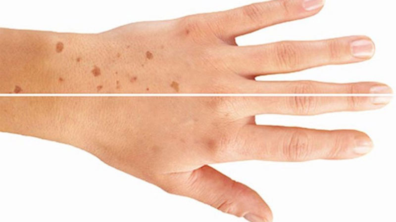 Làm gì khi bạn bị nám da tay? 1