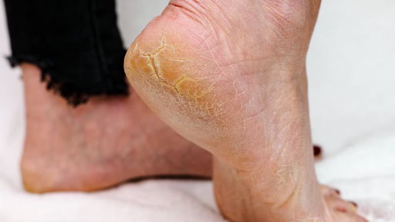 Làm sao để bàn chân trắng mịn và khỏe mạnh? 1