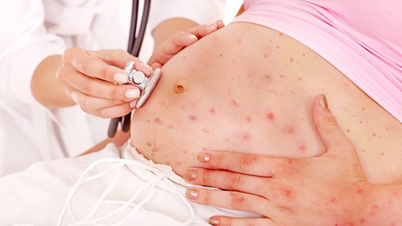 Làm thế nào nếu tiêm phòng thủy đậu 1 tháng thì có thai? 1