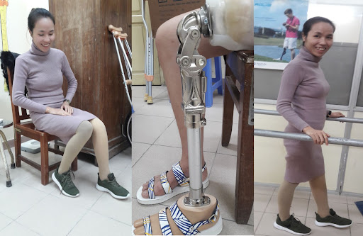 Lắp chân giả: Các bước cần chuẩn bị và lộ trình thực hiện4