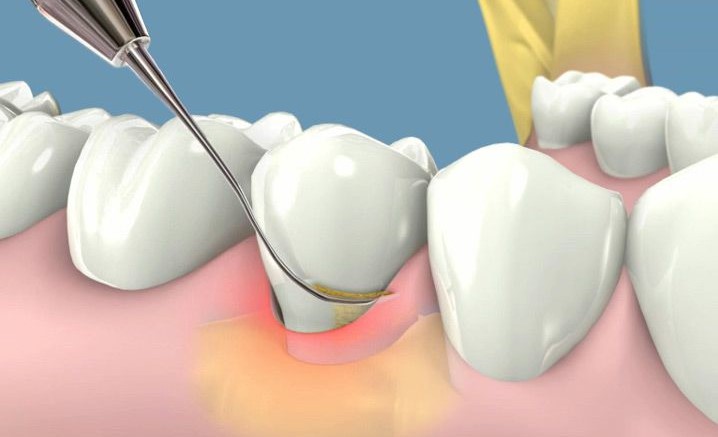 Lấy cao răng bằng máy siêu âm: Ưu điểm, quy trình và những lưu ý cần biết 5