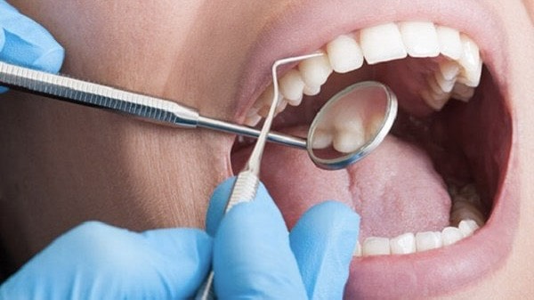 lay-cao-rang-het-bao-nhieu-tien-bao-lau-nen-lay-cao-rang-mot-lan 3