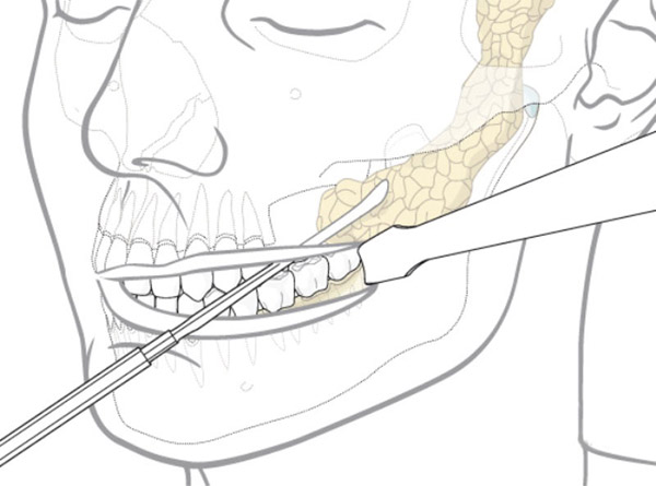 Thắc mắc: Lấy túi mỡ má bao lâu thì lành? 1