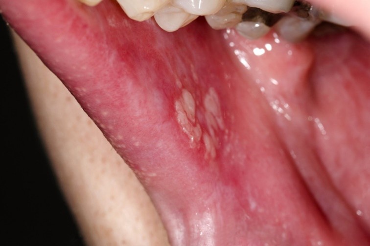 Lichen phẳng: Triệu chứng, nguyên nhân, chẩn đoán và phương pháp điều trị bệnh 4