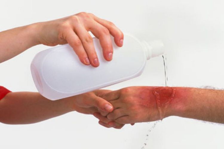 Liệu bỏng cồn có chữa được không? Cách chữa trị như thế nào? 1