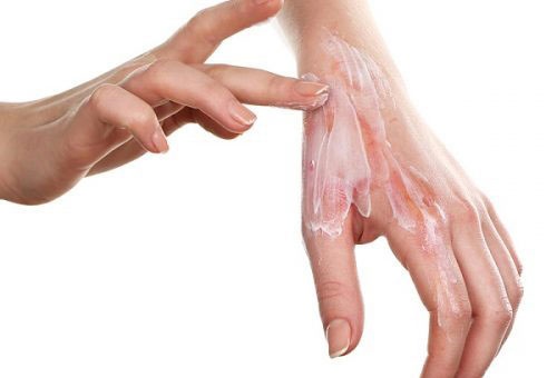 Liệu bỏng cồn có chữa được không? Cách chữa trị như thế nào? 3