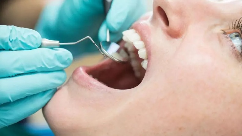 Tìm hiểu: Lấy cao răng có làm răng yếu đi hay không? 3