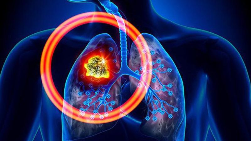 Liquid Biopsy là gì và được thực hiện như thế nào? 2