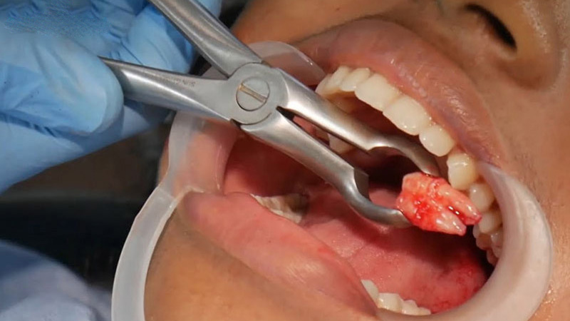 Lỗ hổng sau khi nhổ răng khôn: Nguyên nhân và cách khắc phục 1