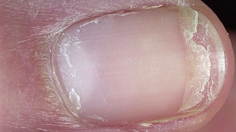 Loạn dưỡng móng và những điều cần biết 2