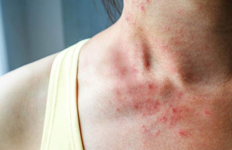 Loạt bệnh về da thường gặp sau mùa mưa lũ cần đặc biệt lưu ý 1