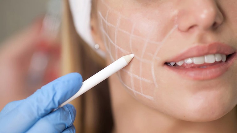 Lợi ích và rủi ro khi hút mỡ mặt 1