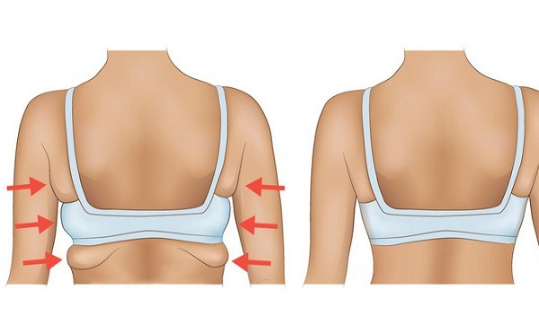 Lợi ích và rủi ro khi hút mỡ vai 3