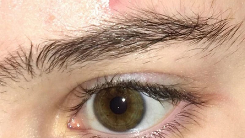 Lông mày mọc ngược là gì? Làm sao xử lý? 1
