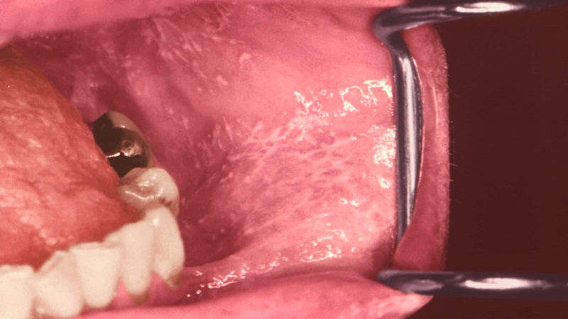 Lớp màng nhầy màu trắng bên trong miệng phát sinh do đâu? 1