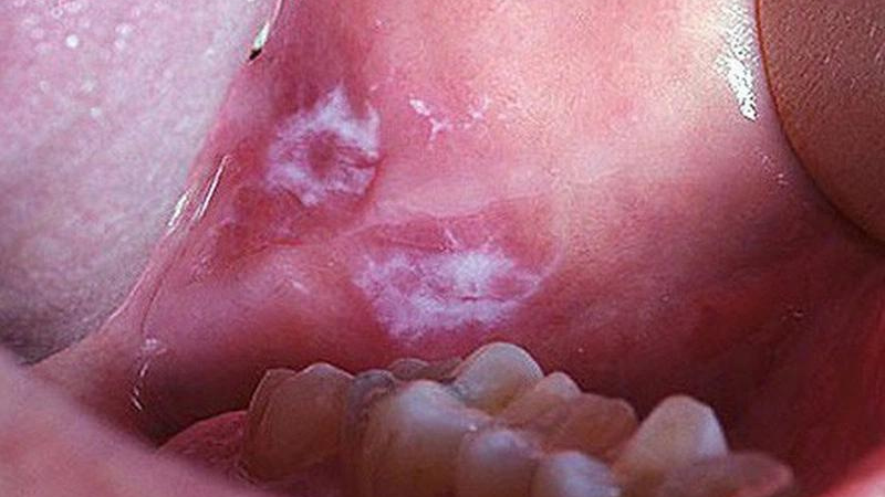 Lớp màng nhầy màu trắng bên trong miệng phát sinh do đâu? 4