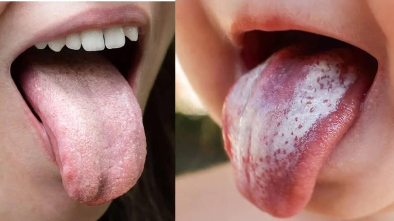 Lớp màng nhầy màu trắng bên trong miệng phát sinh do đâu? 3