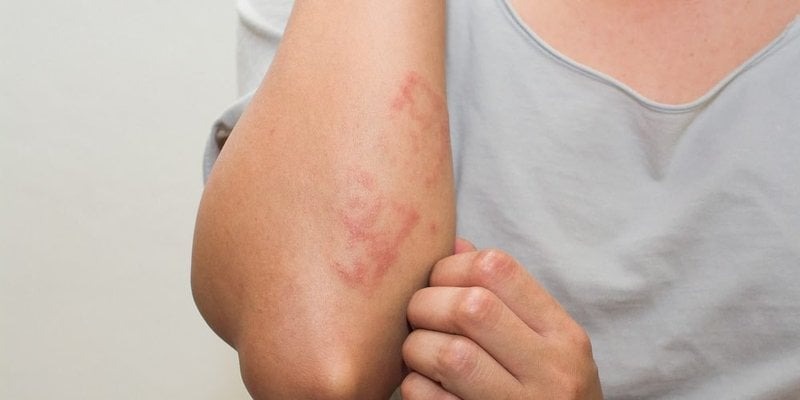 Lưu lại ngay các dấu hiệu của bệnh zona 1