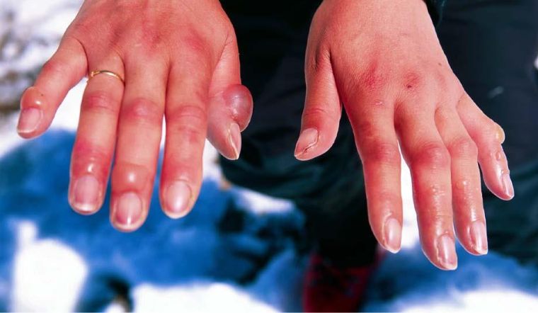 Lưu lại ngay cách sơ cứu bỏng lạnh ai cũng nên biết 2