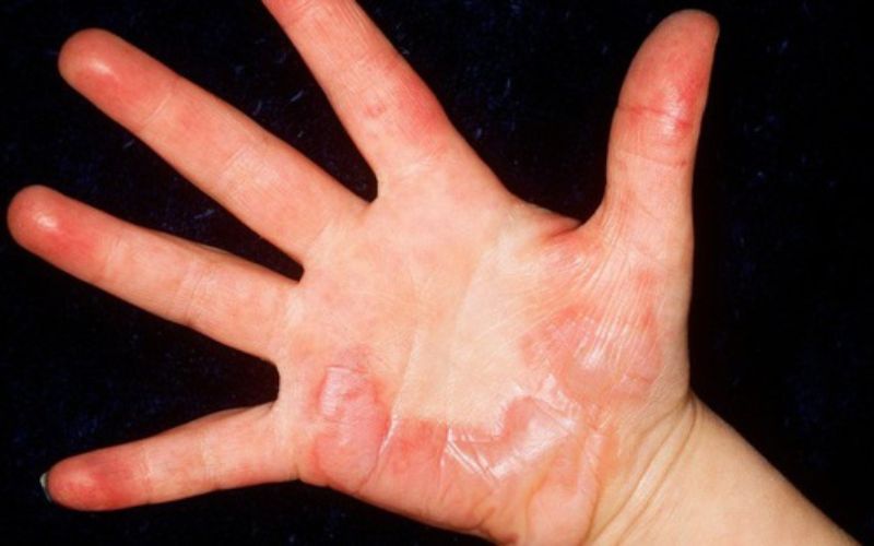 Lưu ngay các dấu hiệu của bỏng lạnh để sơ cứu kịp thời 2