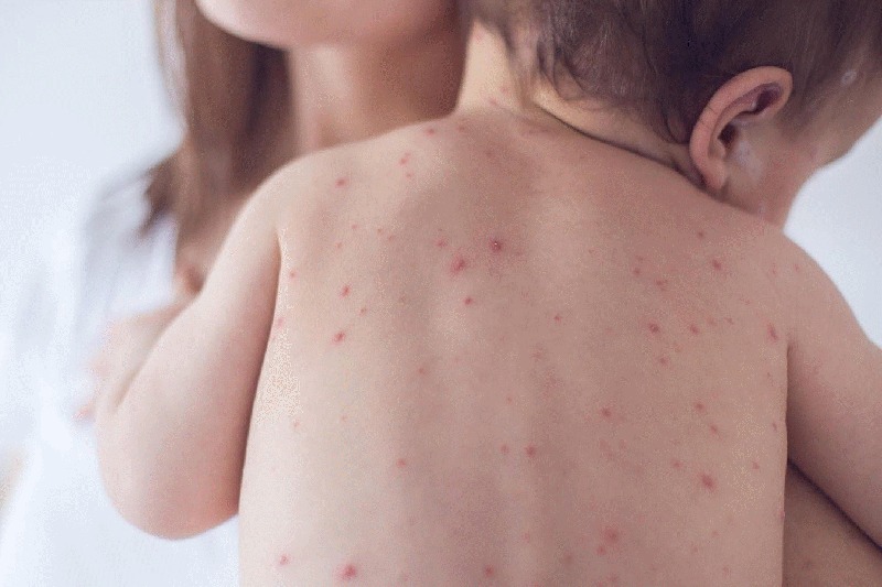 Lưu ý trước khi tiêm phòng sởi, quai bị, rubella 1
