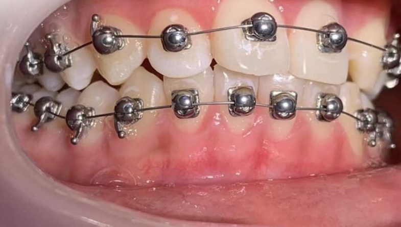 Mắc cài cánh cam: Giải pháp niềng răng thẩm mỹ và những ưu nhược điểm cần biết 3