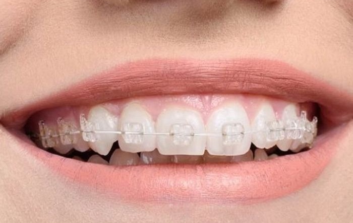 Mắc cài pha lê là gì? Tại sao nên chọn mắc cài pha lê để chỉnh nha? 2