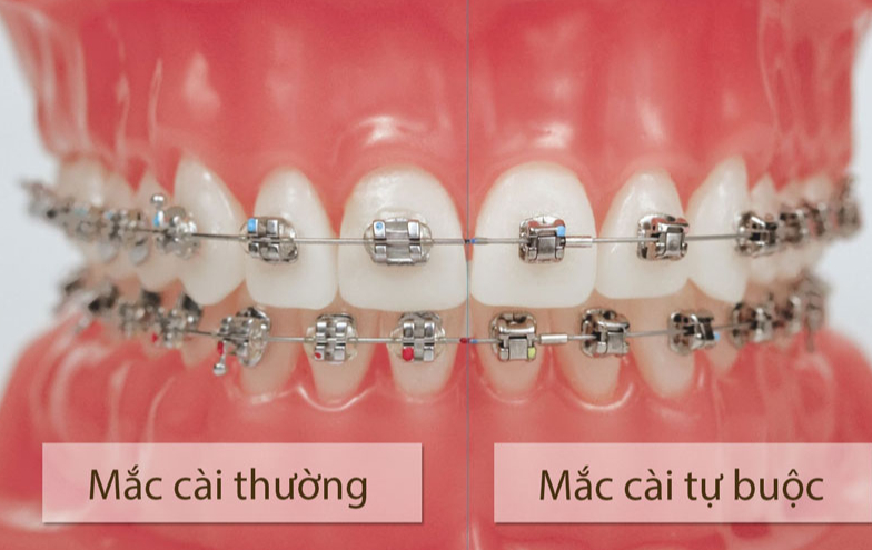 Mắc cài thông minh và mắc cài thường khác nhau như thế nào? 5