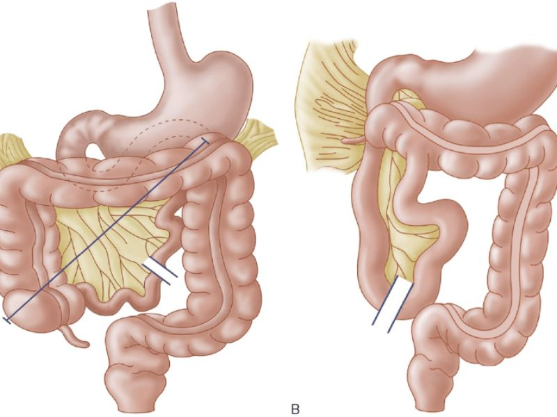 Mạc treo ruột: Cấu tạo, chức năng và các bệnh liên quan 2