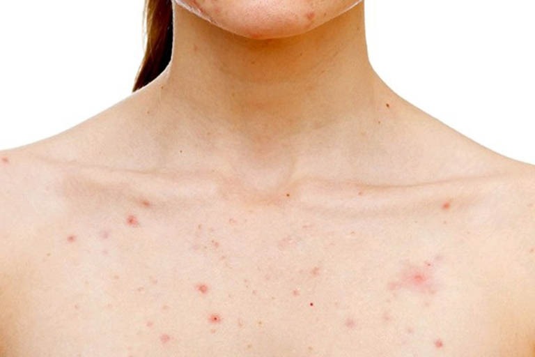 Mách bạn cách chữa viêm nang lông hiệu quả 3