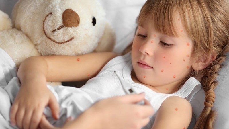 Mách bạn cách phân biệt bệnh tay chân miệng và thủy đậu ở trẻ em 2