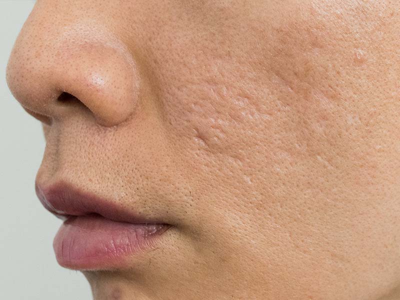 Mách bạn phương pháp trị sẹo rỗ bằng nha đam1