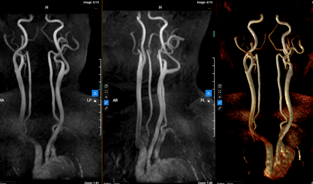 Mạch corrigan là gì? Dấu hiệu cảnh báo và cách điều trị hiệu quả 3