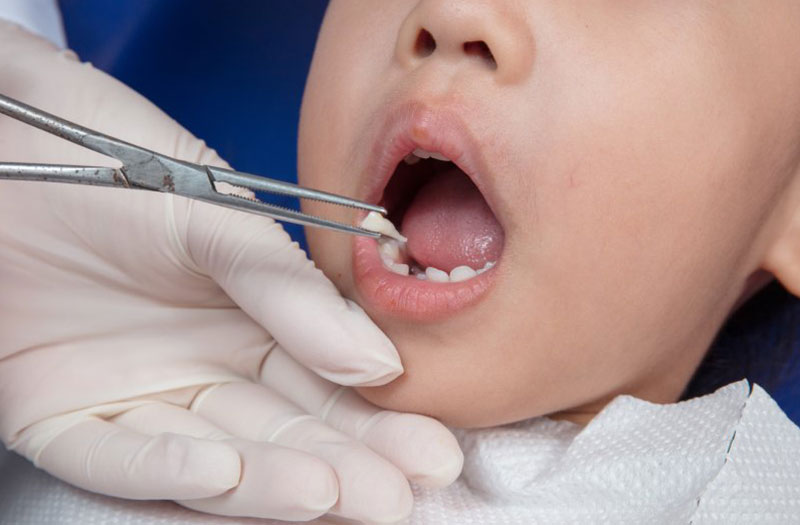 Mầm răng là gì? Thiếu mầm răng vĩnh viễn phải làm sao? 3