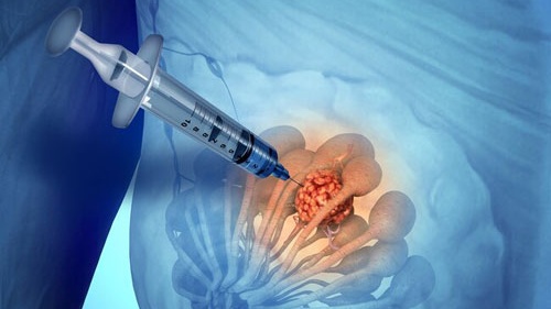 mammography-la-gi-ky-thuat-chan-doan-nay-co-y-nghia-nhu-the-nao 3