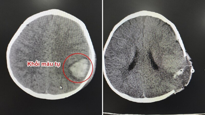 Mất nhận thức là gì? Cách chẩn đoán và điều trị 5