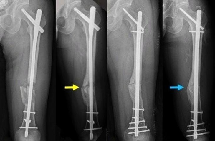 Người bị gãy xương bất vít có đi máy bay được không?