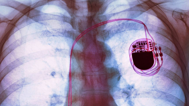 Máy trợ tim là gì? Những ai cần dùng? 1