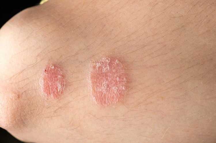 Mẹo chữa bệnh vẩy nến bằng lòng đỏ trứng gà tại nhà 1